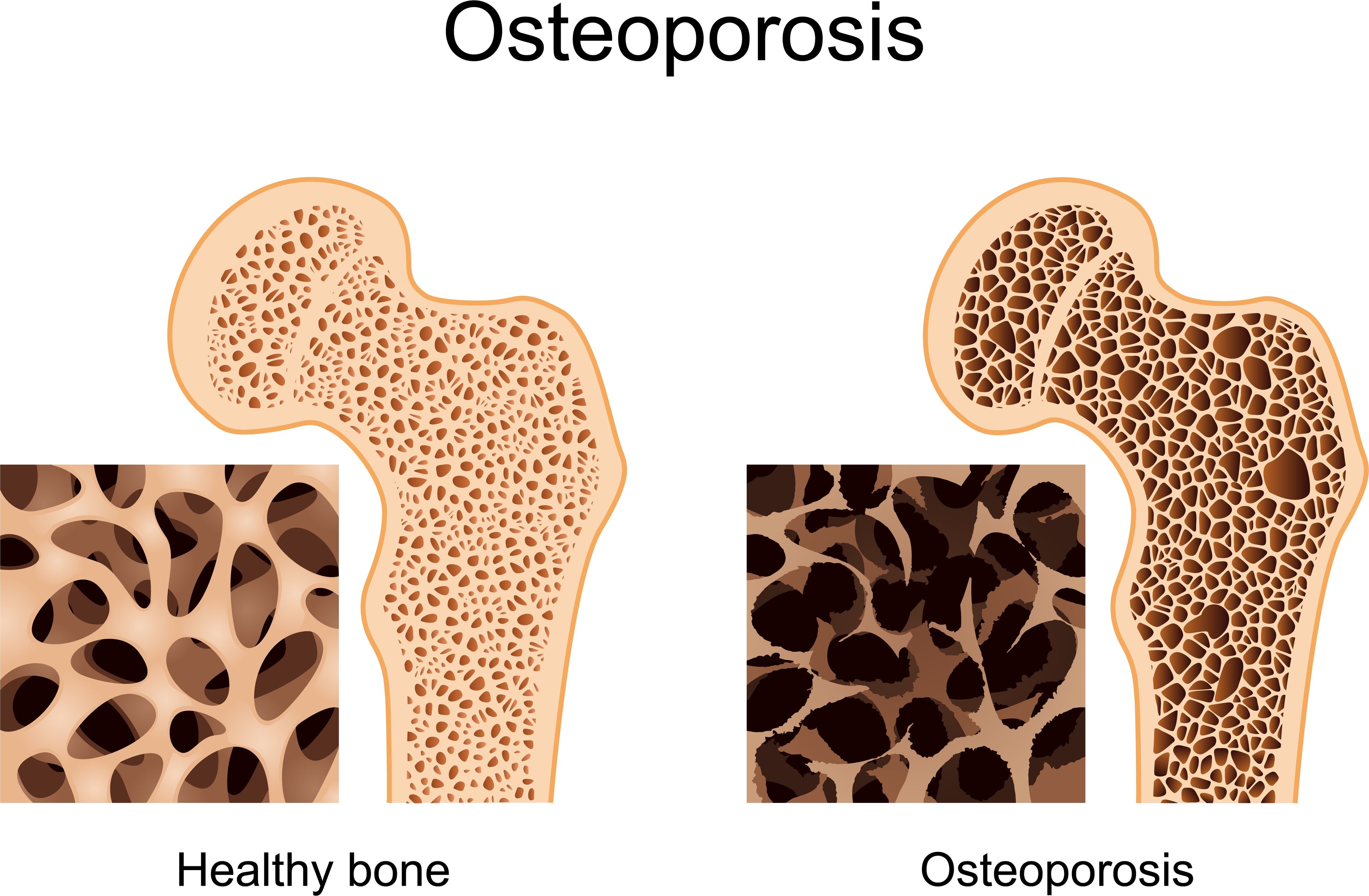 World Osteoporosis Day 20 October 2022 - World Gk